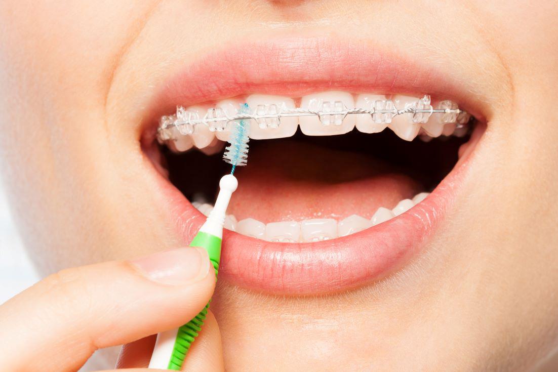 5 Tips For Cleaning Teeth With Braces