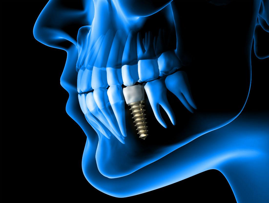 Dental Implants Albany, OR