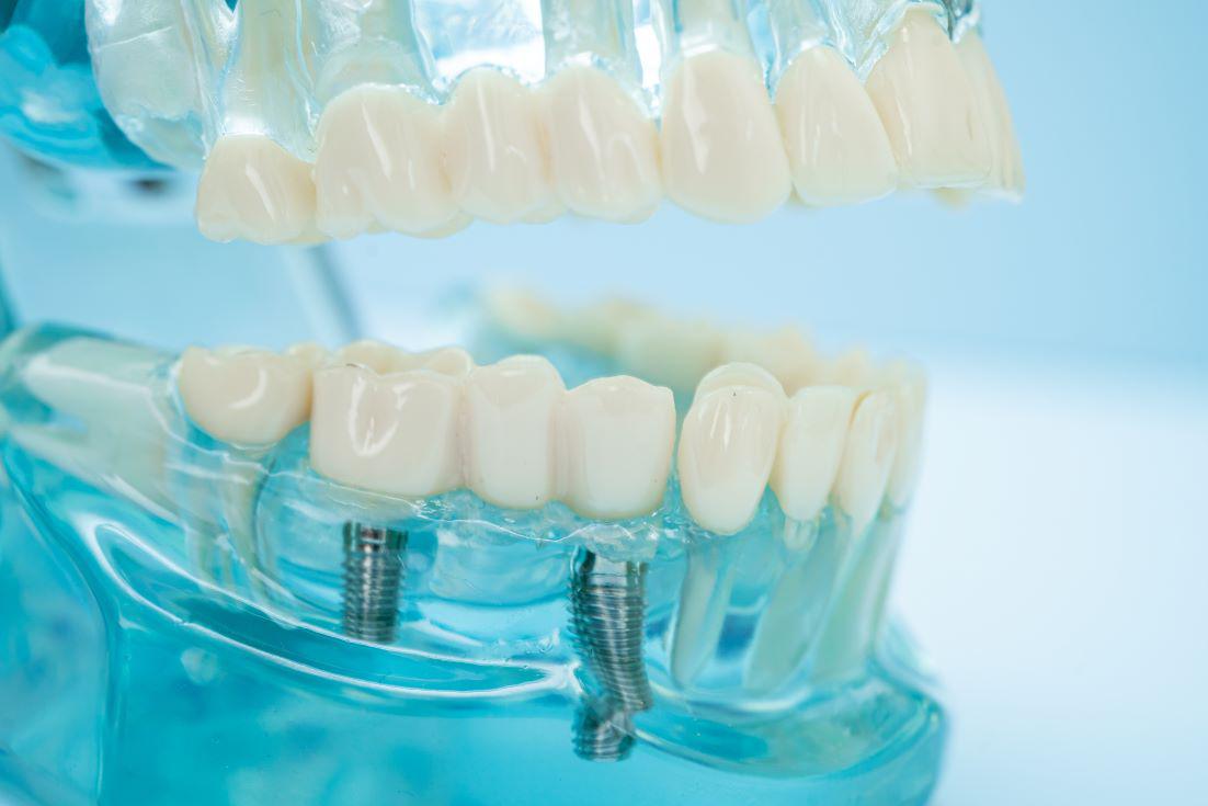 Same Day Implants Albany, OR